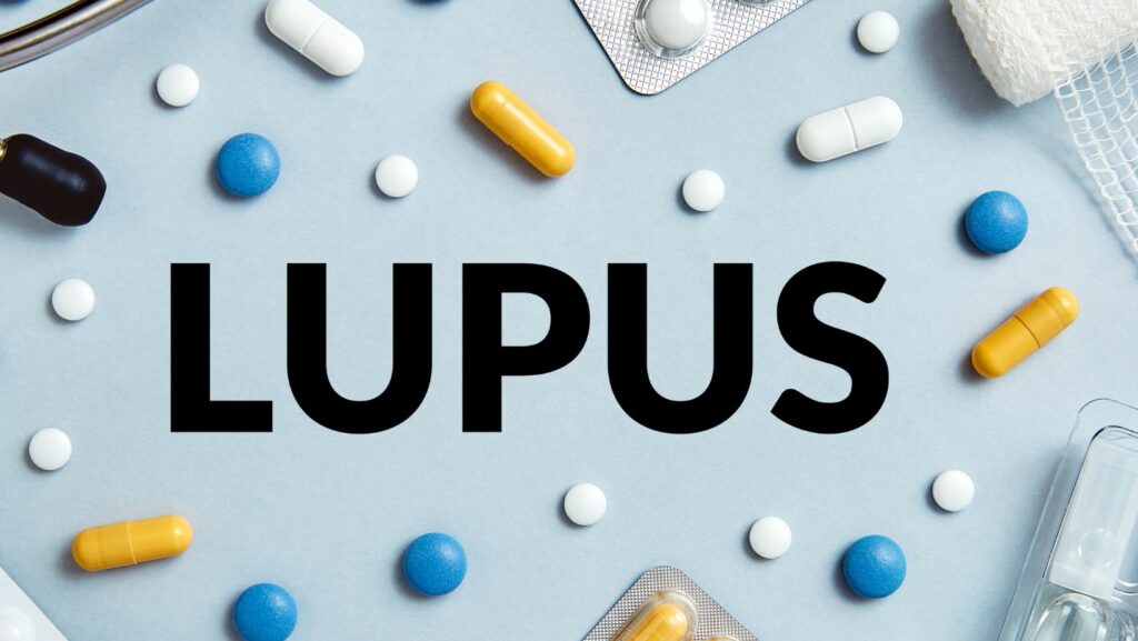 natural remedies for lupus