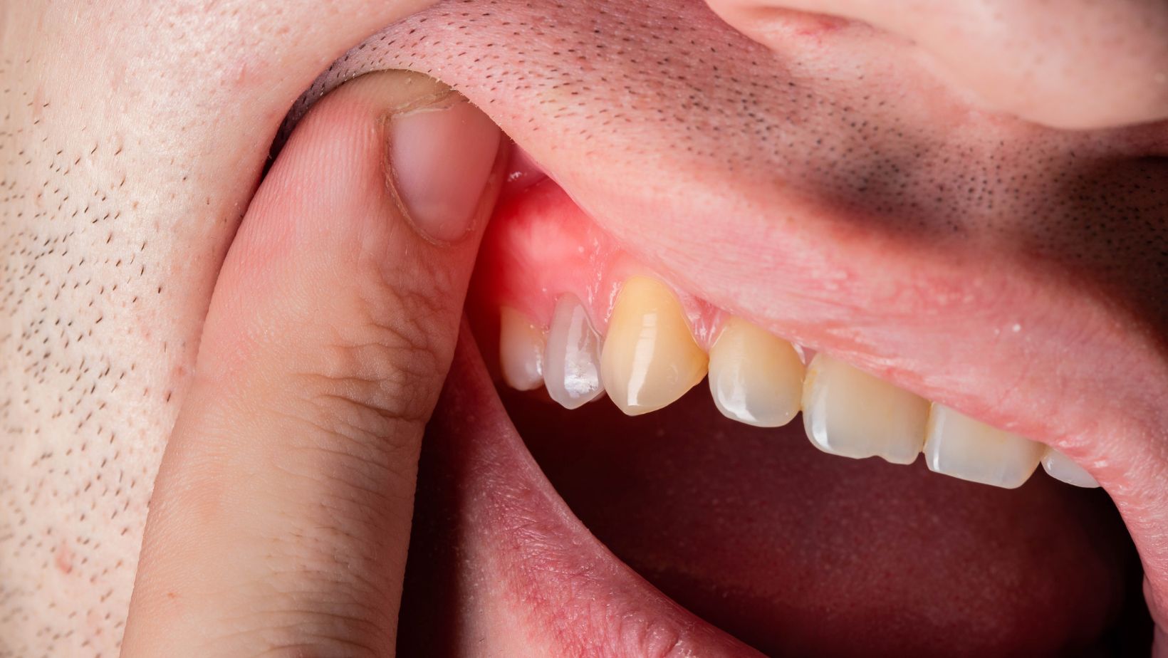 Natural Remedies for Tooth Infection